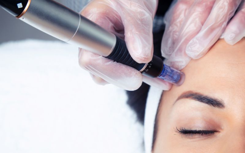 Microneedling met dermapen 4 Vrouw ondergaat een microneedling behandeling voor een strakkere en gladdere huid met minder rimpels