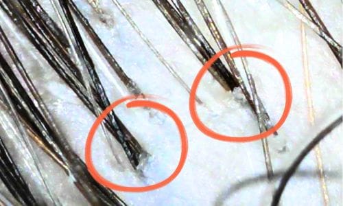 Voor de Japanese Head Spa behandeling bij Gold and Glow, klant Sharine - hoofdhuid vet en verstopte poriën, haar voelt zwaar aan