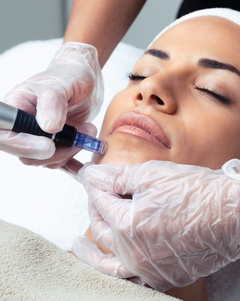 Boek microneedling Gold and Glow Almere